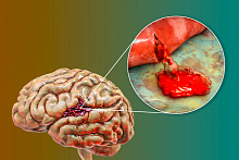Травматическое повреждение мозга и риск инсульта