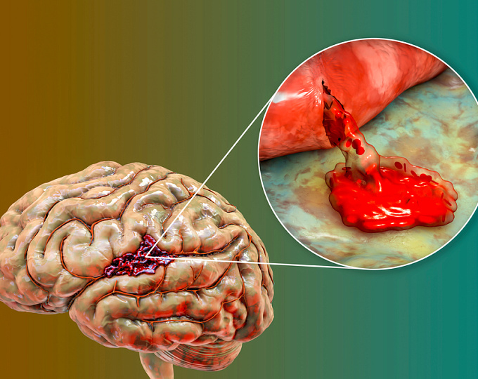 Травматическое повреждение мозга и риск инсульта