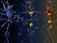 Болезнь Альцгеймера и эпилепсия, существует ли между ними причинно-следственная связь?