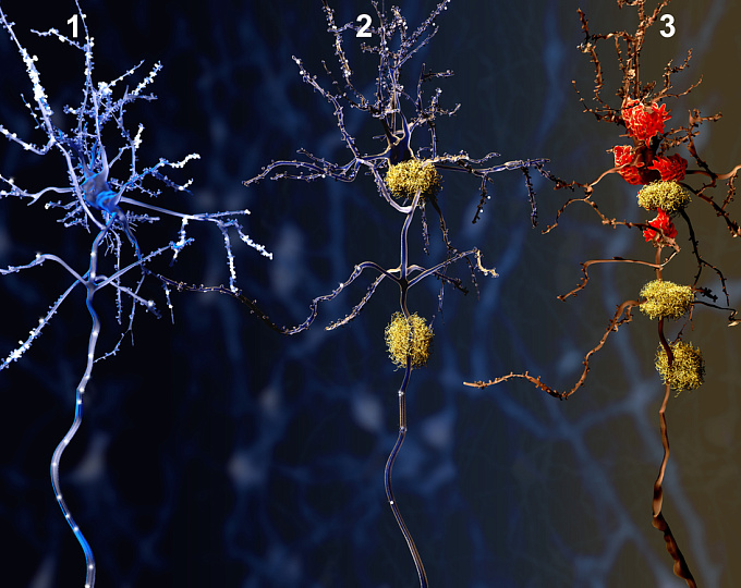 Болезнь Альцгеймера и эпилепсия, существует ли между ними причинно-следственная связь?