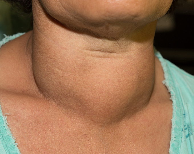 Связь метаболического синдрома и рака щитовидной железы