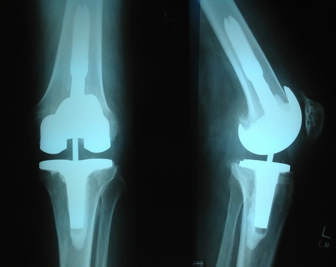 Эндопротезирование коленного сустава и качество жизни пациентов после операции
