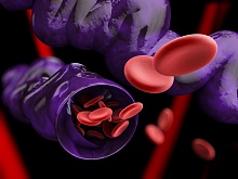 Эффективность фармакомеханического тромболизиса при тромбозе глубоких вен 