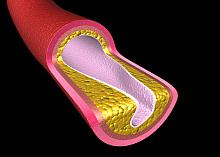 Сравнение стентирования сонных артерий и эндартерэктомии. Результаты 3 исследований 