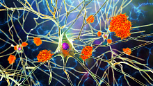 Болезнь Альцгеймера и эпилепсия: есть ли связь?