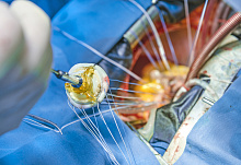 Транскатетерная или хирургическая замена аортального клапана у пациентов с аортальным стенозом?