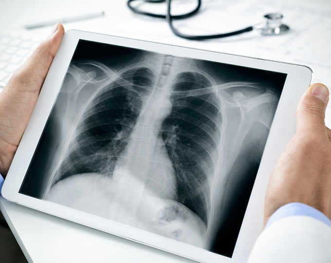 Не следует проводить радиографию грудной клетки для исключения острого аортального синдрома 