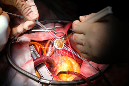 Риск инфекционного эндокардита после хирургического и транскатетерного протезирования аортального клапана