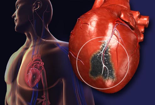 Риск развития инфаркта миокарда с подъемом сегмента ST у молодых курильщиков