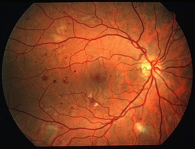 Диабетическая ретинопатия (положения Американской Диабетологической Ассоциации) 