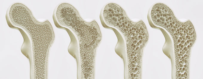 Актуальные вопросы лечения пациентов с остеопорозом