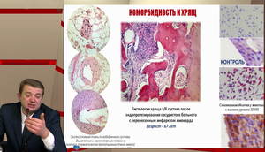 VI Международный Интернет Конгресс специалистов по внутренним болезням. День 1. Симпозиум «Пациент с остеоартрозом на амбулаторном приёме» 