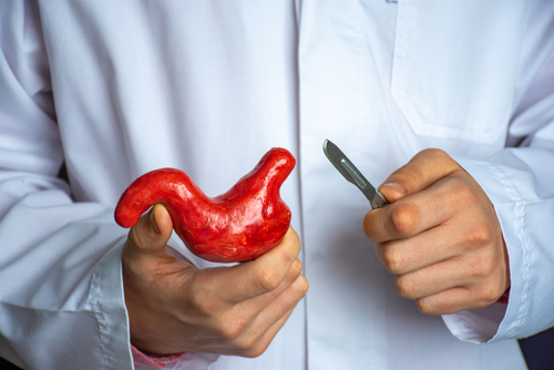 Новый порог потери веса для ремиссии СД2 после бариатрической хирургии