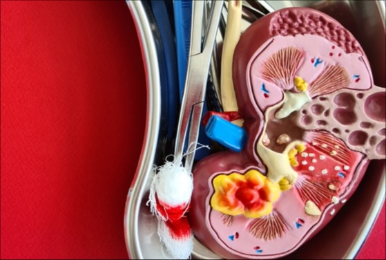 Субклинический первичный гиперальдостеронизм и сердечно-сосудистые события