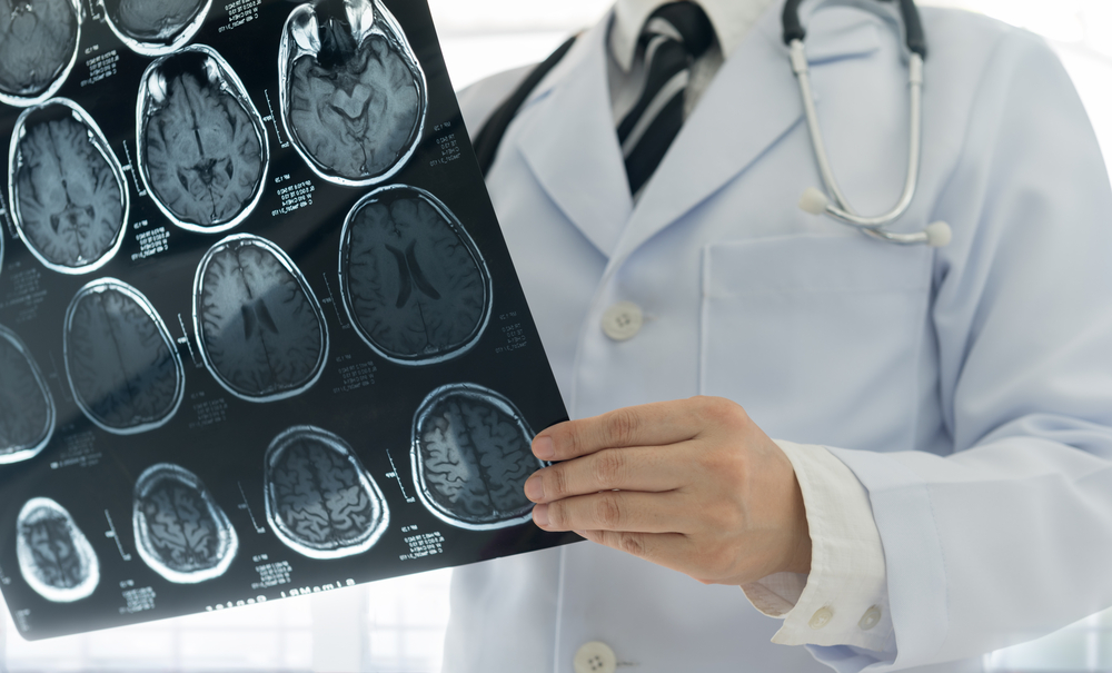 INTERSTROKE: вакцинация против гриппа уменьшает риск инсульта