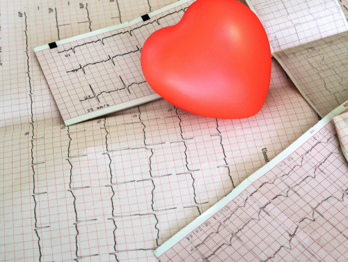 Стенокардия напряжения: достаточно только наблюдения?