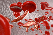 Лечение язв на ногах у пациентов с серповидно-клеточной анемией