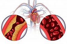 Точность скрининга болезни периферических артерий. Акцент на лодыжечно-плечевой индекс