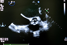 Сравнение транскатетерной и хирургической замены аортального клапана