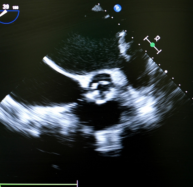 Сравнение транскатетерной и хирургической замены аортального клапана