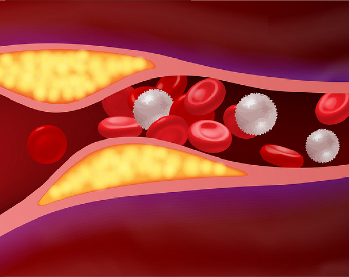Оптимальная стратегия антитромботической терапии у пациентов с ФП, перенесших инсульт