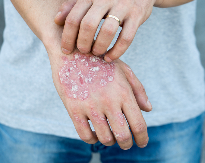 Сокращение интервала между инъекциями сецукинумаба у пациентов с ожирением как путь к клинической ремиссии 