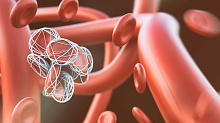 Содержание тромбоцитов в кровяном сгустке может повлиять на результаты тромбэктомии