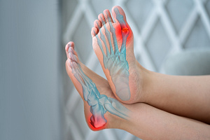 Ингибиторы SGLT2 снижают потребность в препаратах для лечения подагры