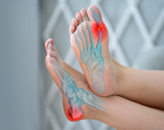 Ингибиторы SGLT2 снижают потребность в препаратах для лечения подагры