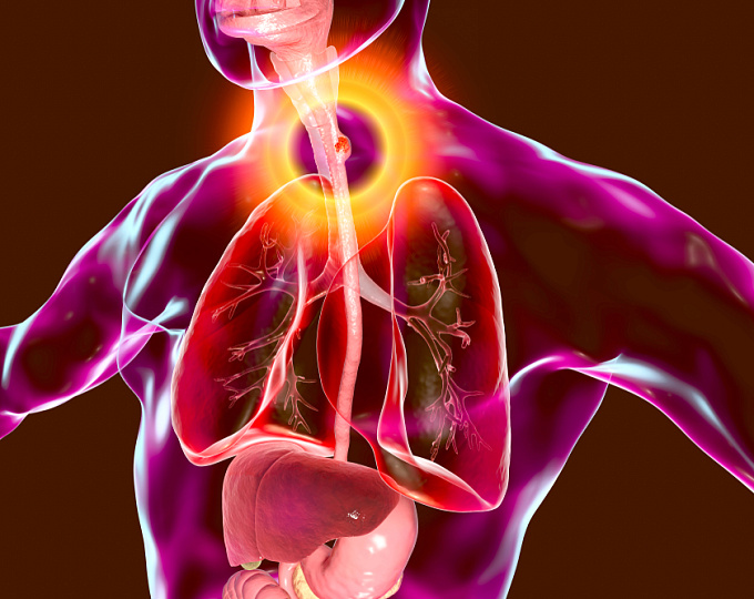 Рост заболеваемости пищеводом Баррета и аденокарциномой пищевода