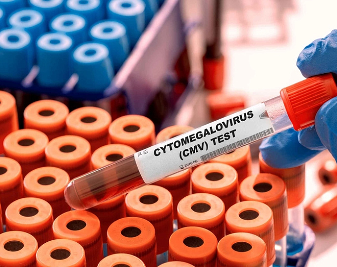 Связь между болезнью Альцгеймера и цитомегаловирусной инфекцией