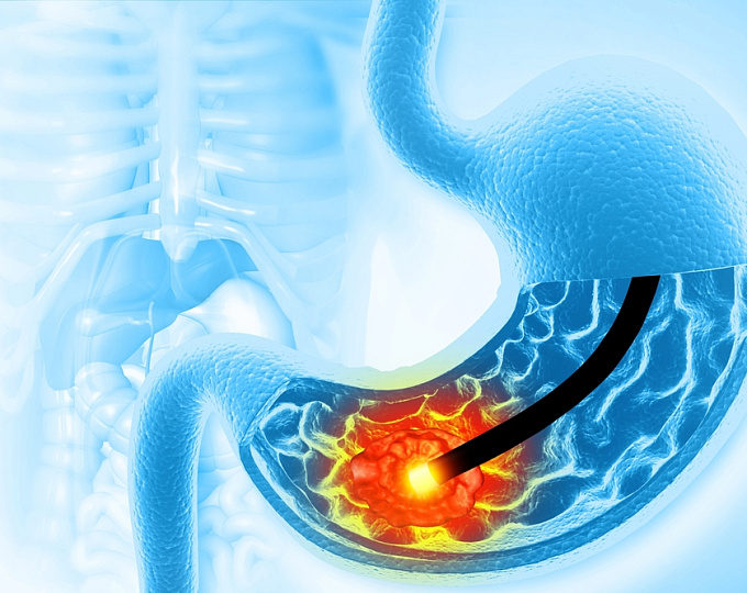 Какое влияние оказывает терапия агонистом рецептора ГЛП-1 на риск пептической язвенной болезни?