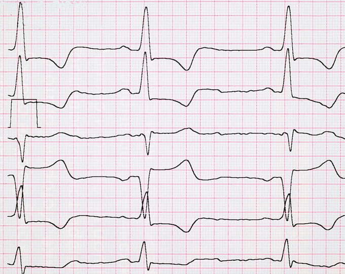 Реваскуляризация у хрупких пациентов с острым коронарным синдромом