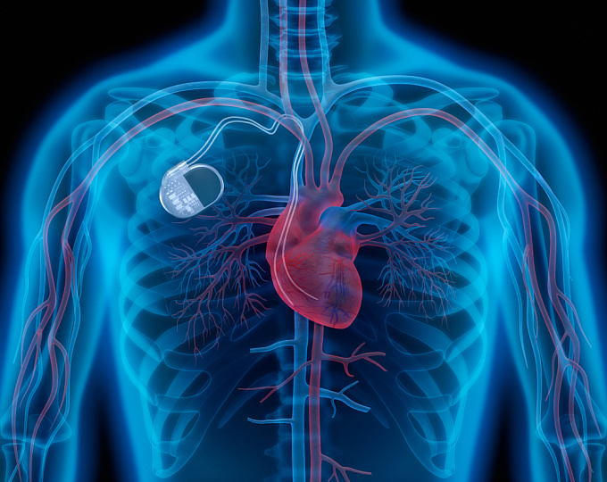 Подкожный или трансвенозный bмплантируемый кардиовертер-дефибриллятор (ИКД): основные результаты исследование PRAETORIAN
