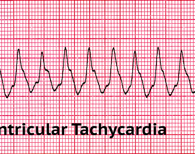 Неинвазивное лечение жизнеугрожающих желудочковых аритмий уже реальность?