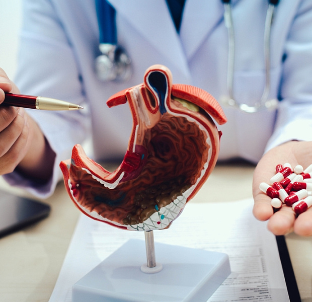 Риск развития аденокарциномы желудка на фоне длительной антисекреторной терапии ингибитором протонной помпы