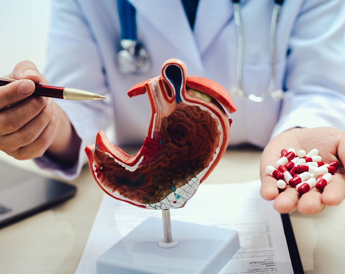 Риск развития аденокарциномы желудка на фоне длительной антисекреторной терапии ингибитором протонной помпы