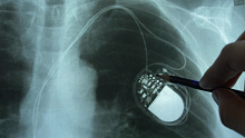 Распространенность транстиретиновой кардиомиопатии у пациентов с кардиостимулятором