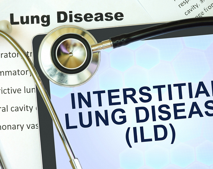 Интерстициальные болезни легких: есть ли надежда на пирфенидон?