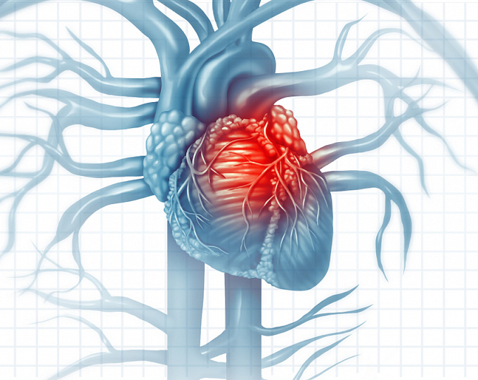 Реваскуляризация при стабильной ИБС у пациентов с ХСН