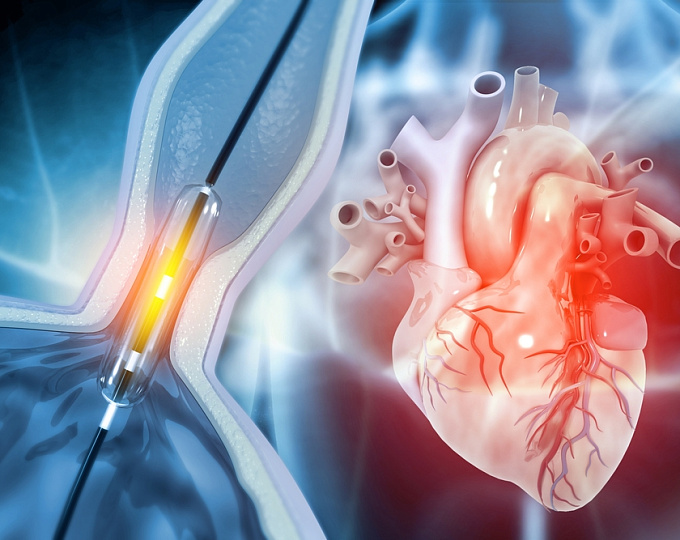 Как минимизировать осложнения со стороны ЖКТ после ЧКВ?