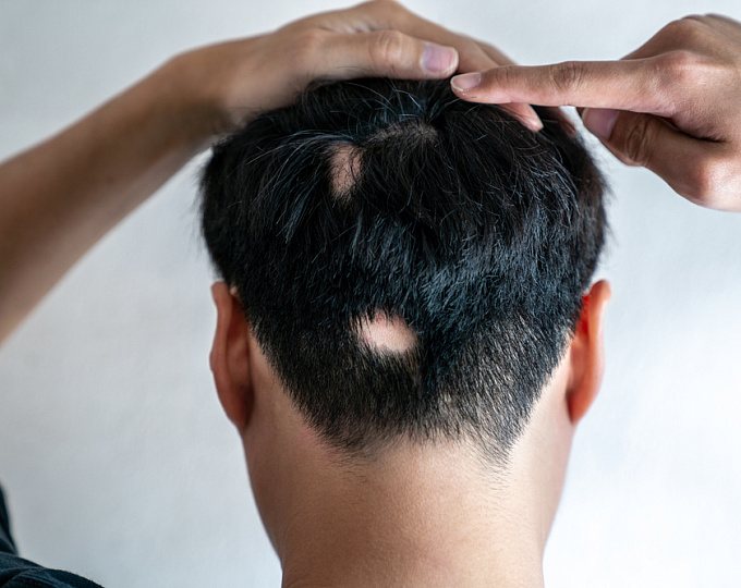 Ментальное здоровье пациентов с очаговой алопецией