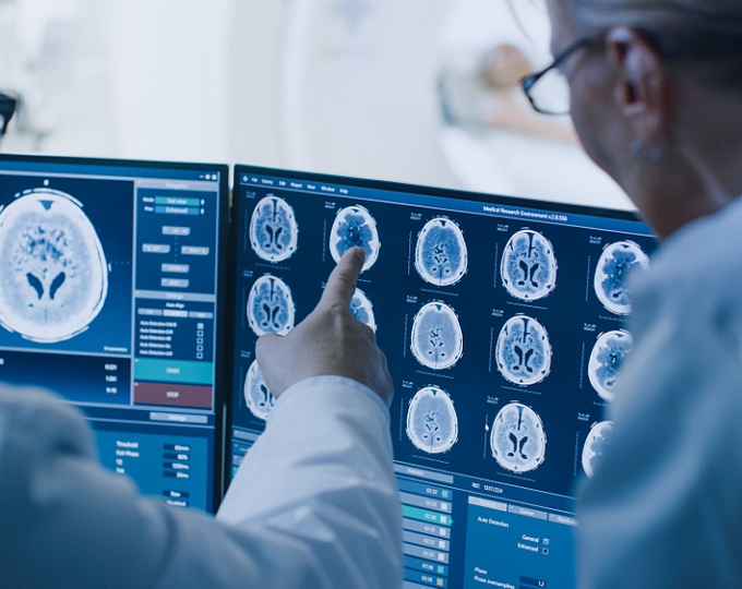 Частота и прогностическое значение инфаркта головного мозга, выявленного с помощью МРТ, у пациентов легким неврологическим дефицитом