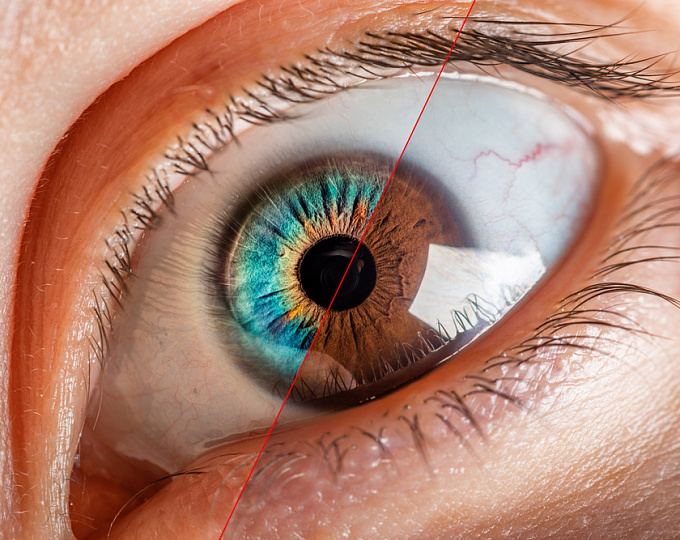 Сравнение результатов роговичной аберрометрии и ригидности склеры в нормальных и глаукоматозных глазах
