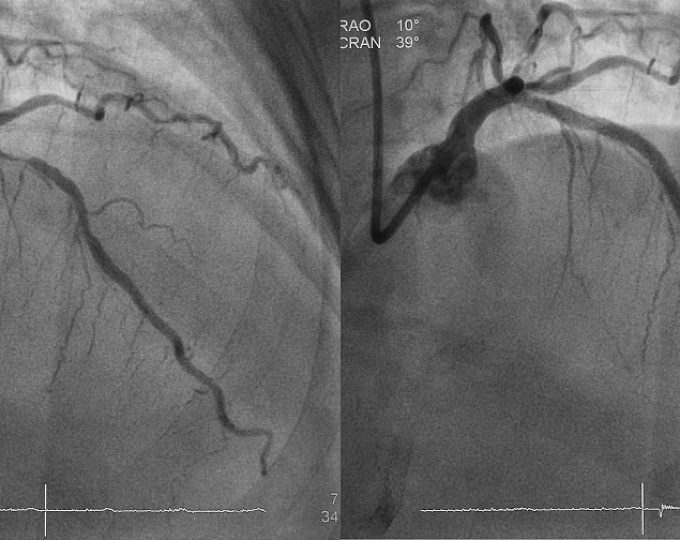 Лучевой или бедренный доступ при ЧКВ в случае ИМспST?