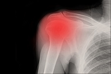 Превосходят ли инвазивные методы лечения синдрома «замороженного плеча» физиотерапию?