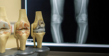 Влияние варфарина и прямых оральных антикоагулянтов на риск протезирования коленного и тазобедренного сустава