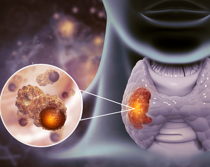 Оптимальная тактика ведения пациентов с дифференцированным раком низкого риска