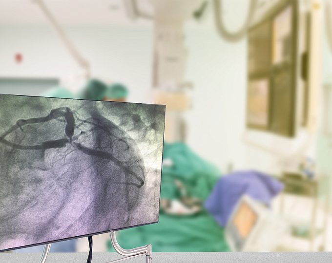 ЧКВ у пациентов с ишемической сердечной недостаточностью: ждать ли улучшения прогноза?