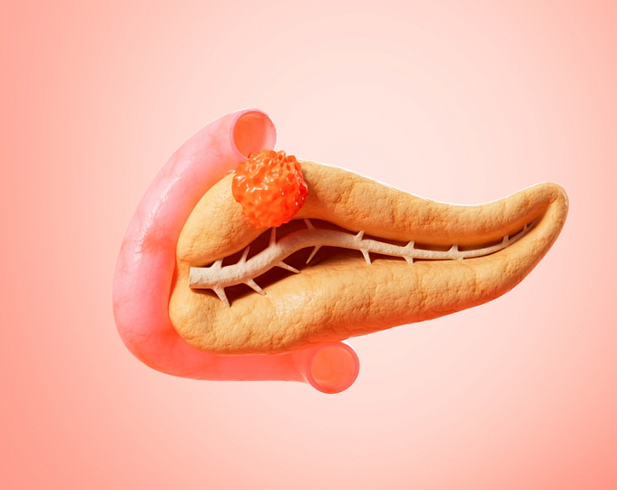 Особенности острого панкреатита, ассоциированного с гипертриглицеридемией